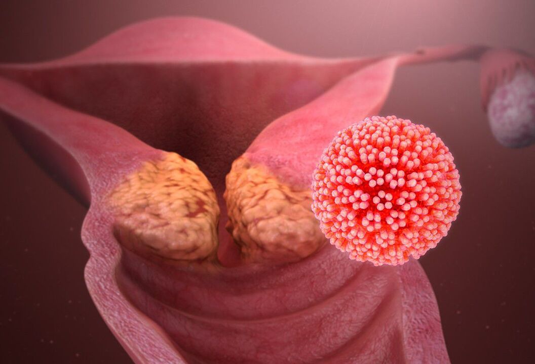 HPV-Gebärmutterhalsverletzung