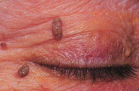 Papillome auf der Haut der Augenlider, die einer Behandlung bedürfen. 