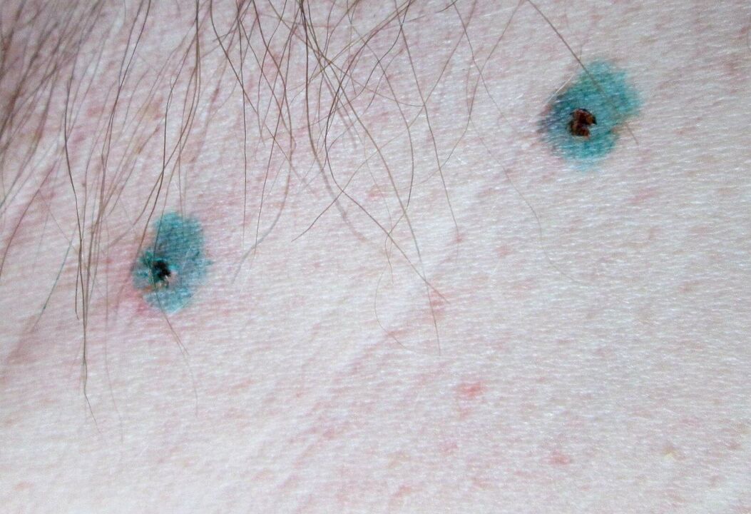 Flecken auf der Haut nach Laser-Papillomentfernung. 